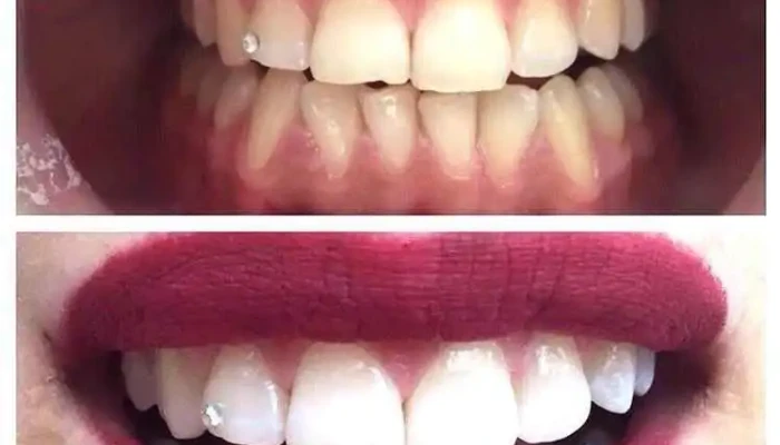 Dental -  Lm Zab - Боговиње