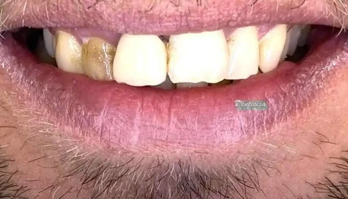 Denticija -  Zab - Гевгелија