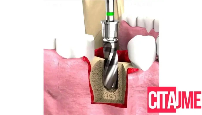 Korona -    Dental Od Sopstvenikot - Гевгелија
